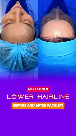 Her forehead has been reduced in proportion to her face. #Trending #facelift #cosmetics #plasticsurgery #viral 