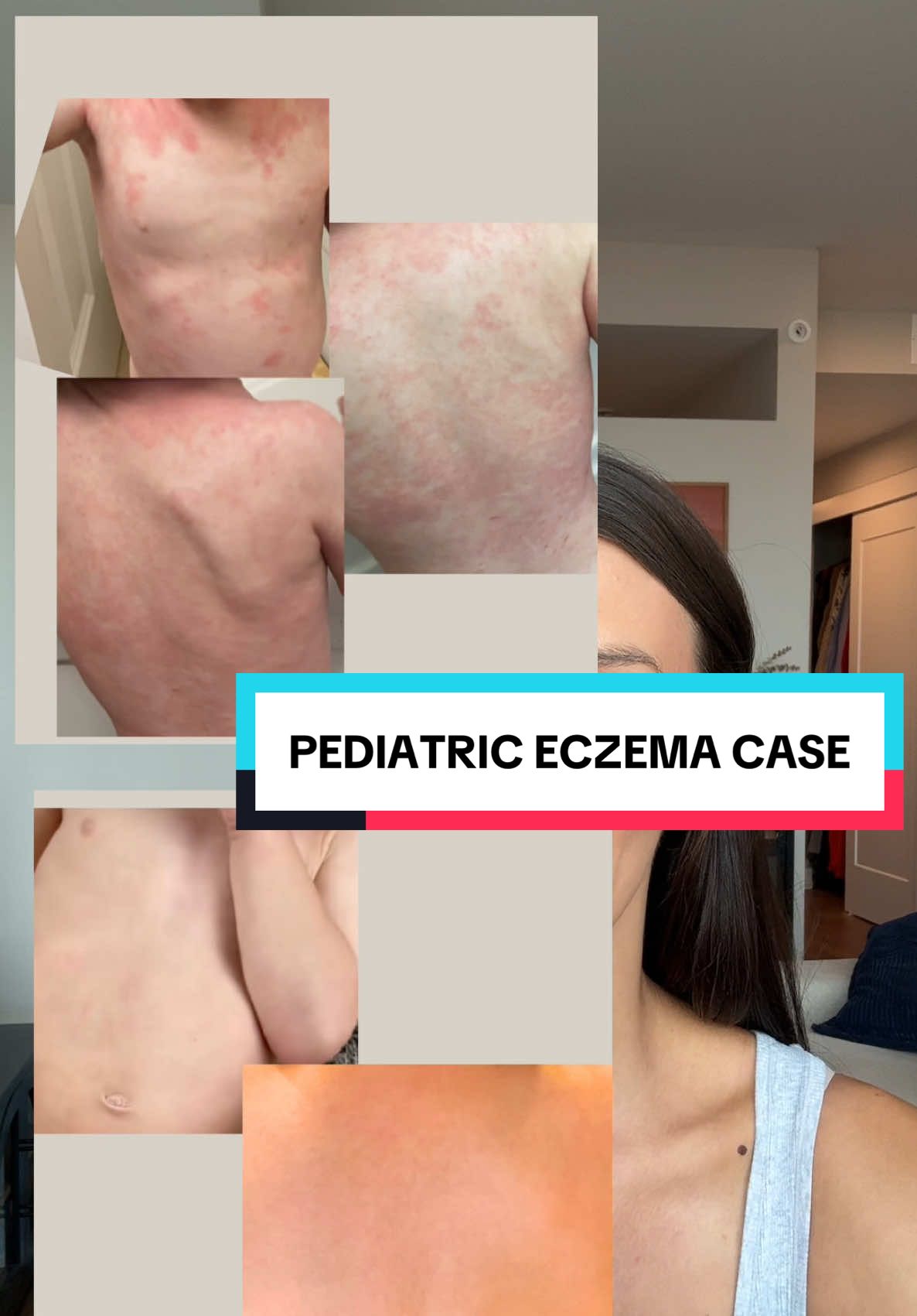 Pediatric eczema case! Mold, Candida, and gut dysbiosis! #mold #mycotoxins #candida #eczema #gimap