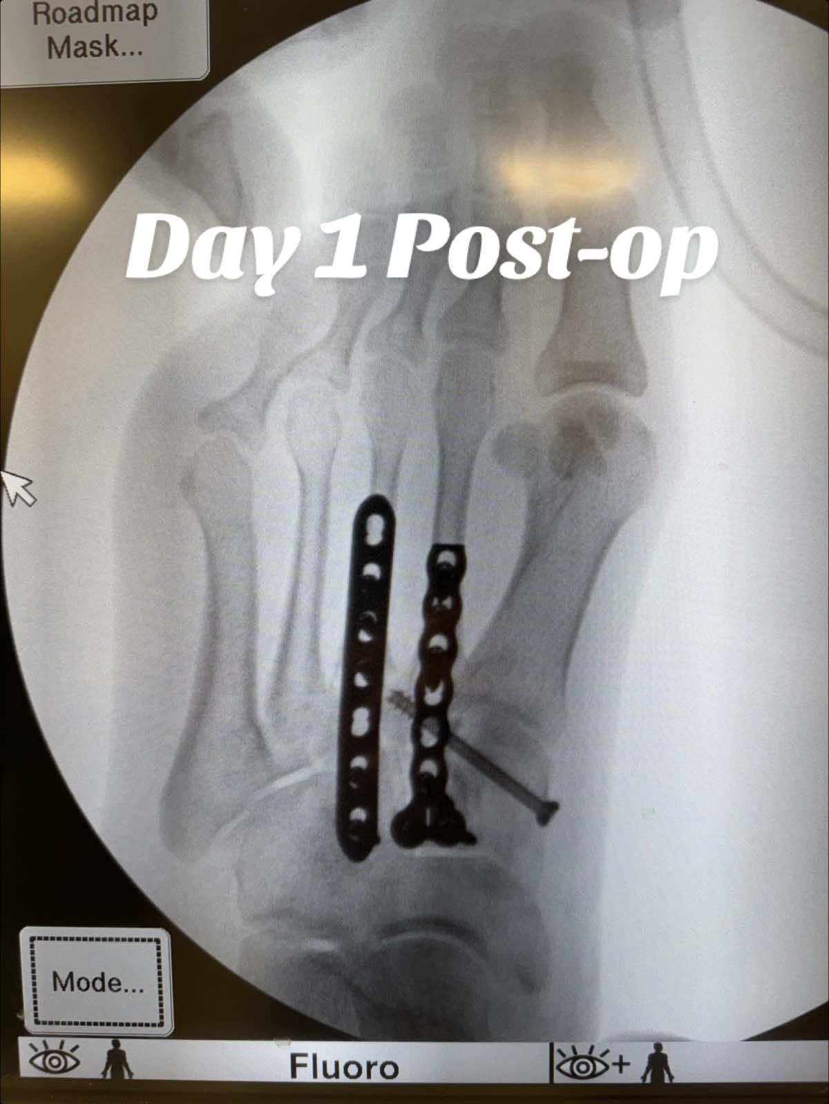 😭 ain’t no more kekeing im in pain!!!!! Omfg! Nerve block still somewhat there. #nerveblock #nerveblockworeoff #footsurgery #fypシ #lisfrancinjury 