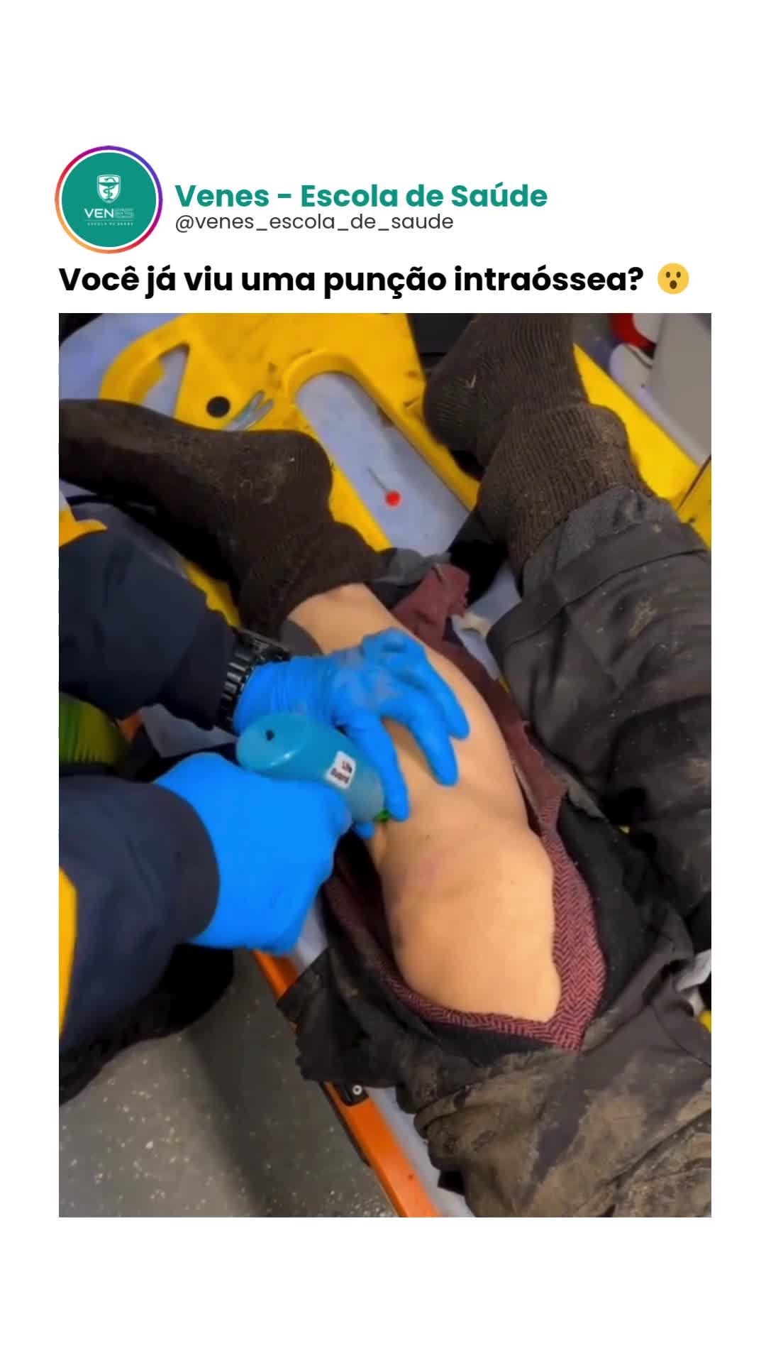 A punção intraóssea é uma técnica que pode salvar vidas em situações de emergência, quando o acesso venoso convencional é inviável. Você sabe como e quando utilizá-la? 🔎 O que é a punção intraóssea? É um método de acesso ao sistema vascular utilizando a medula óssea como via de administração de fluidos, medicamentos e coleta de exames, essencial para casos críticos. 🩺 Quando utilizar? Em pacientes em estado grave ou choque. Quando não é possível obter um acesso venoso periférico rapidamente. 📍 Locais mais comuns para a punção: Tíbia proximal. Fêmur distal. Úmero proximal (em adultos). ✅ Dica importante: Realize sempre com técnica estéril e avalie a necessidade de troca para um acesso venoso definitivo assim que possível. 💬 A técnica correta faz toda a diferença! 💬 Gostou desse vídeo? Deixe seu comentário! 📹: Direct para créditos/remoção. . . . . . #punçãointraossea #enfermagemporamor #Enfermeiros #EstudantesDeEnfermagem #enfermagem
