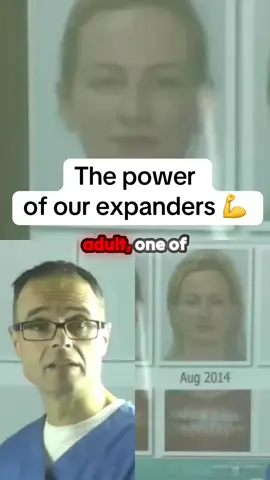 MAXILLA has an incredible effect on every other bone in your face. Wide maxilla: -pushes cheekbones out -protects eye area  -allows lower jaw to develop -projects chin  -leads to hollow cheecks -expands your airways  -improves sleep  -EVEN improves cognitive functioning #widemaxilla #maxilla #maxillaexpander #palateexpander #mewingshop #mogged #chicolachowski #jordanbarrett #mewing #looksmax #GlowUp #fyp #expand #health #airways