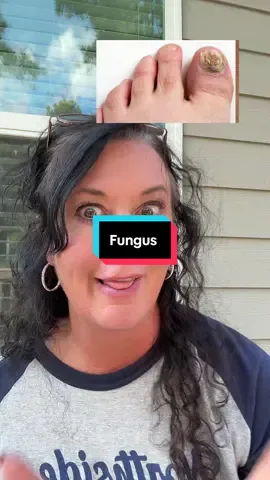 #fungus #antifungaltreatment #footfungus #naturalremedies  results may vary 