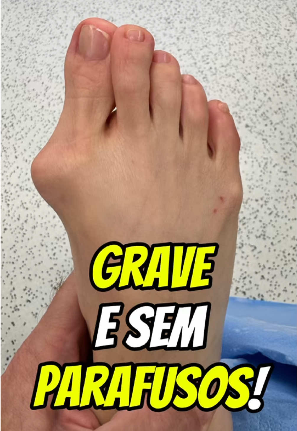 #joanete #bunion #haluxvalgo 