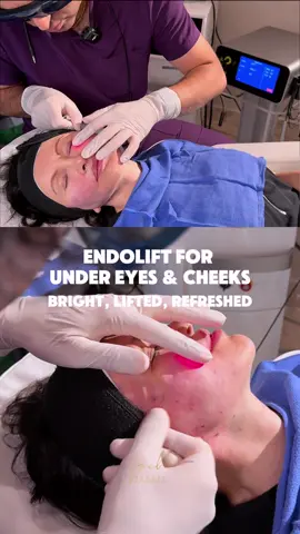 ✨ Say goodbye to tired eyes & sagging cheeks! ✨ Our Endolift treatment brightens, lifts & refreshes under eyes and cheeks—instantly revealing a youthful glow 💫 #Endolift #CheekLift #UnderEyeRejuvenation #GlowUp #SkinGoals  
