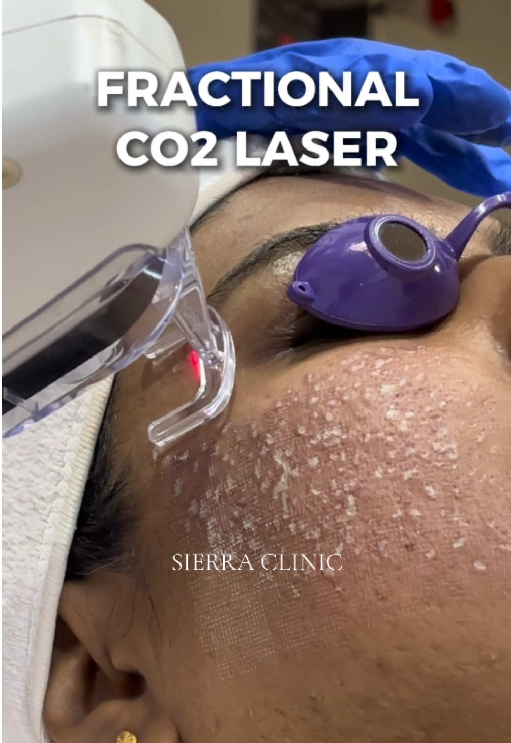 #co2laser #acnescars #fractionalco2laser #laser #fyppppppppppppppppppppppp 