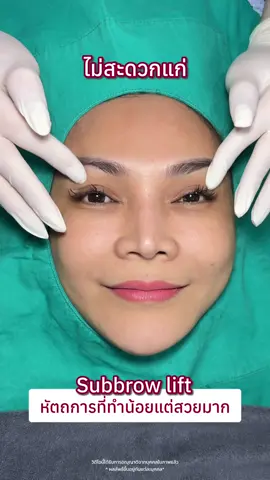 หลังทำ Subbrow lift 👉 หนังตาที่เคยตก ดูยกกระชับขึ้นทันตา ✨ #ตาสองชั้นsky9 #sky9eyeclinic #subbrowlift #subbrow 