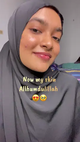 My two Months of acne journey😇#acne #skincare #foryoupage #viral 