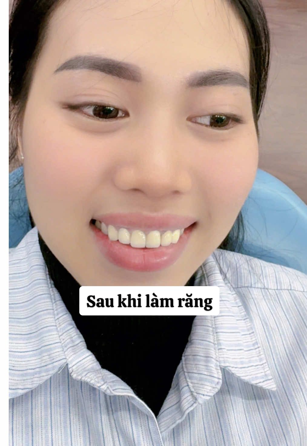 Phục hình răng sứ thẩm mỹ cho chị gái tại Hệ Thống Nha khoa Pari's Bình Dương 🦷 Giờ thì chị đã tự tin cười thật rạng rỡ rồi nhé 😍 Tư vân zl 0918091407 #nhakhoauytin #nhakhoaparisbinhduong #phuchinhrangsu #bocrangsu 