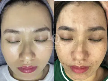 Cập nhật da sạm #lấynhanmunbangtay#chamsocdamun#chamsocdaseo#chamsocdanam#tanbinh 