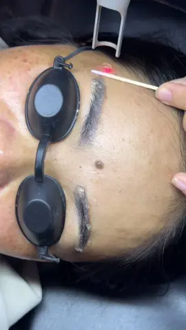 Xoá sửa chân mày #xoachanmaylaser #xoaxamlaserpico #xoachanmay #phunxambienhoa #xoasuachanmay 