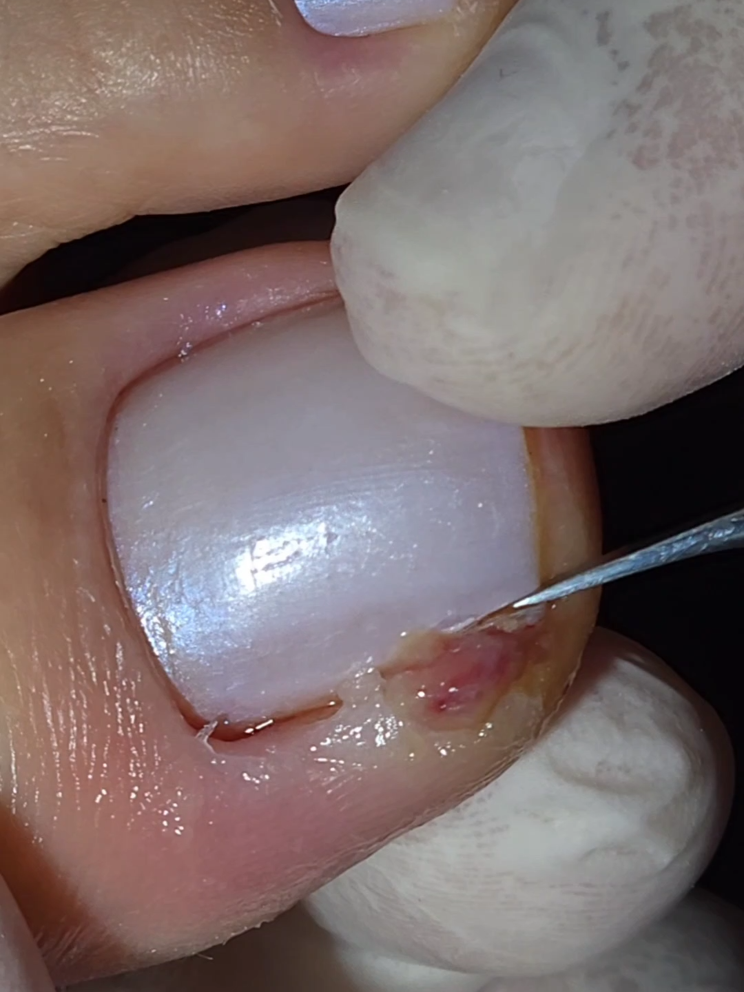 ESSE DEDO TAVA UM PERIGO!#podologomaurelio #podologia #unhas