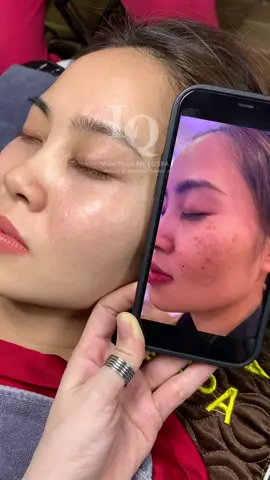 Cập nhật Nám Đinh#chamsocdaseo#chamsocda#chamsocdamun#chamsocdanam#tanbinh     