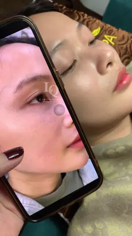 Mới 1 buổi peel trẻ hoá#lấynhanmunbangtay#chamsocdamun#chamsocdaseo#chamsocdanam#tanbinh    &Acedemy