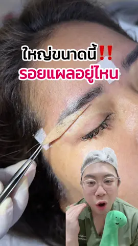 ใหญ่ขนาดนี้รอยแผลอยู่ไหน⁉️ #หมอเฟิร์นfernclinic #ตาสวย #subbrowlift #ศัลยกรรม #เทรนวันนี้ 