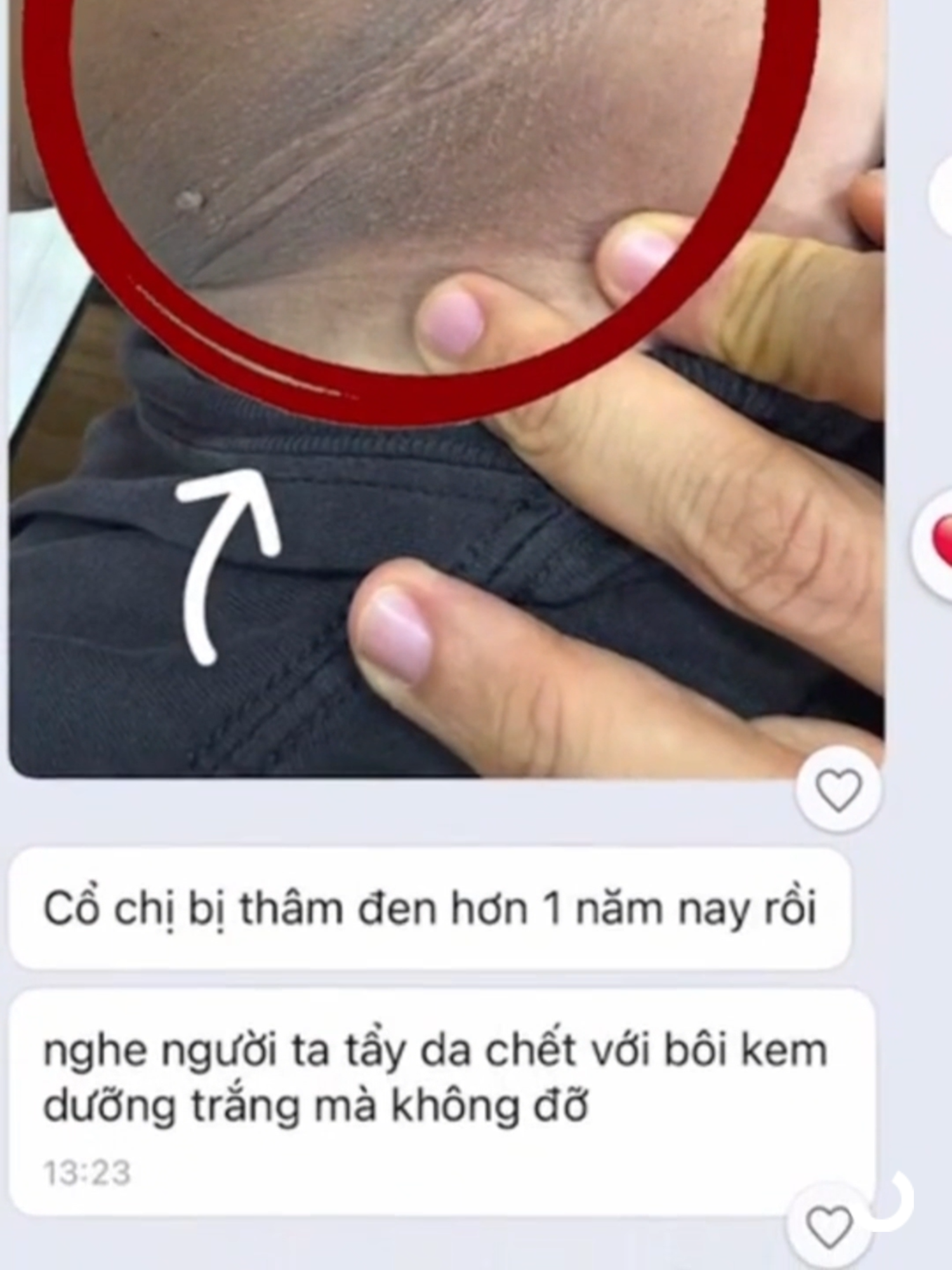 cải thiện gai đen cổ cho con nhé các mom#thamda #thamco #motham