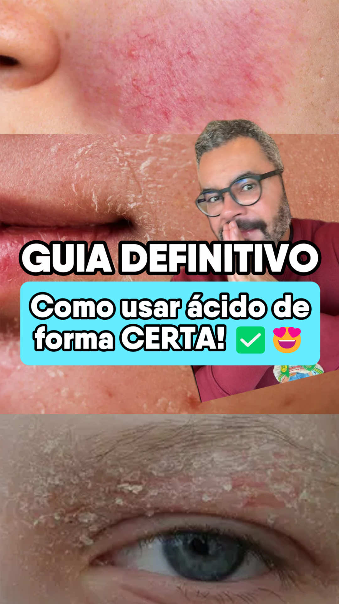 Vem descobrir de uma vez por todas como usar ácidos (como retinol) p/ NUNCA MAIS manchar ou ter sensibilidade. Vou te mostrar os passos explicadinhos que vc precisa seguir, pra não sensibilizar seu rosto 😍♥️ #acidoretinoico #retinal #tretinoina #retinol #retinolskincare 
