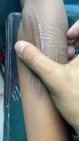 #scarremoval #scar #scarsheet 