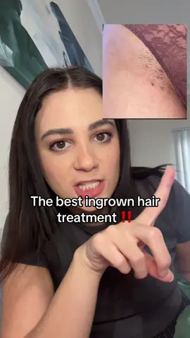 I have never been smoother since using this stuff! 🪒 #ingrownhair 