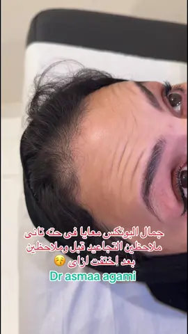 البوتكس معانا فى حته تانى لعلاج الخطوط ☺️#botox #عيادات_تجميل #جلديه_تجميل_ليزر #فراكشنال_ليزر_لعلاج_حب_الشباب #cupcut 