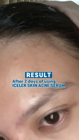 My new fav acne serum!! 🥰#icelerskin #acne #serum #koreanskincare #fyp 