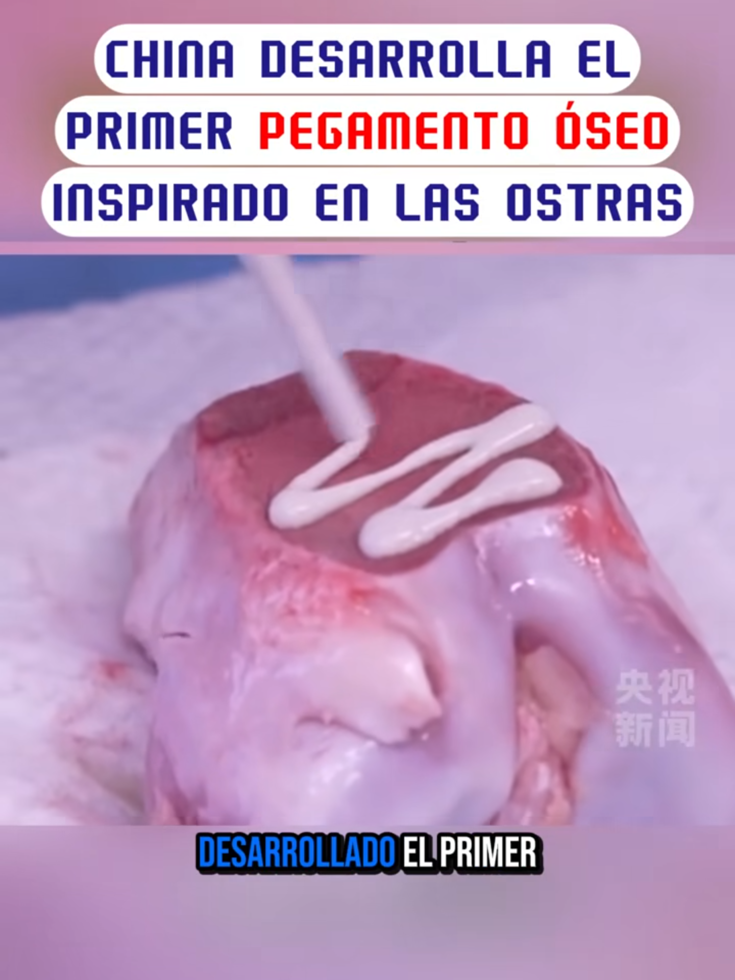 Este pegamento óseo, desarrollado por científicos chinos, permite soldar los huesos en cuestión de minutos y evitar, en muchos casos, una doble cirugía. #salud #medicina #fracturas #ciencia #China #tecnologia