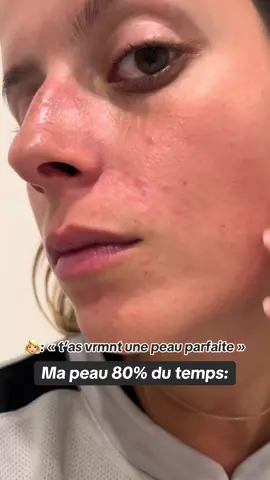 Merci à mes girls qui complimentent toujours ma peau mais elle est n’est pas parfaite 🫶🏼 merci la dermatite periorale  ⚠️Ne croyez pas tout ce qu’on voit sur les réseaux  #dermatitis #dermatiteperioral #skin #skincondition 