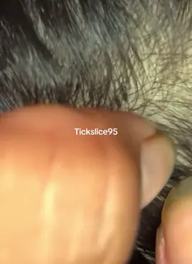 #removelice #tiktokindia #omg😱 #lice 