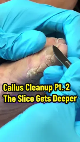 Back for round ✌️ of this tough callus cleanup 🔪 The deeper we go, the more satisfying it gets, wait until you see the finish 👀 Would you sit through this whole treatment? #fyp #callus #footpain #oddlysatisfyingvideo #transformation 
