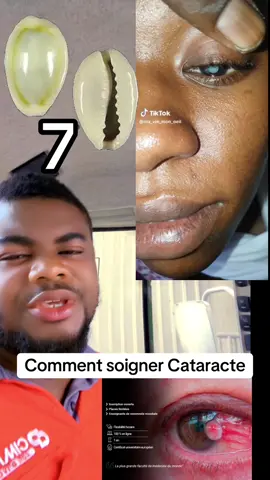 Comment soigner Cataracte#burkinafaso🇧🇫 #cotedivoire🇨🇮 #foryoupage❤️❤️ #togolais228🇹🇬 #bénin🇧🇯 