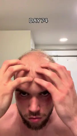 REVERSING HAIR LOSS naturally. Sticking to this for 6-8 months. #hairregrowth #naturalhaircare #hairloss 