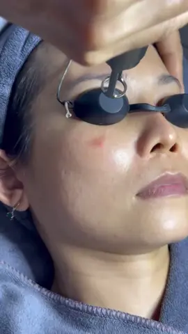 ✨ Trị Nám Bằng Laser – Giải Pháp Hiện Đại Cho Làn Da Sáng Mịn ✨ Nám da là nỗi lo lớn của nhiều chị em, khiến gương mặt kém tươi tắn và thiếu tự tin. Công nghệ laser hiện đại chính là giải pháp an toàn, nhanh chóng và hiệu quả trong việc xóa mờ các mảng nám cứng đầu. 🔹 Cơ chế hoạt động: Tia laser tác động trực tiếp vào chân nám, phá vỡ hắc sắc tố melanin và đào thải ra ngoài theo cơ chế tự nhiên, không gây tổn thương da. 🔹 Hiệu quả: Giảm nám rõ rệt sau liệu trình, giúp da đều màu, sáng mịn và khỏe mạnh hơn. 🔹 Ưu điểm: An toàn, ít đau rát, không cần nghỉ dưỡng dài ngày. 👉 Nếu bạn đang lo lắng vì nám, hãy để công nghệ laser giúp bạn lấy lại làn da sáng khỏe và sự tự tin rạng rỡ ☘️Spa Leo☘️ #munloikhuan #namkhongbong #spaganday #nangcotrehoa #hongbikini  🏠79/6B1, quốc lộ 13, phường Bình Thạnh 📞0372365110