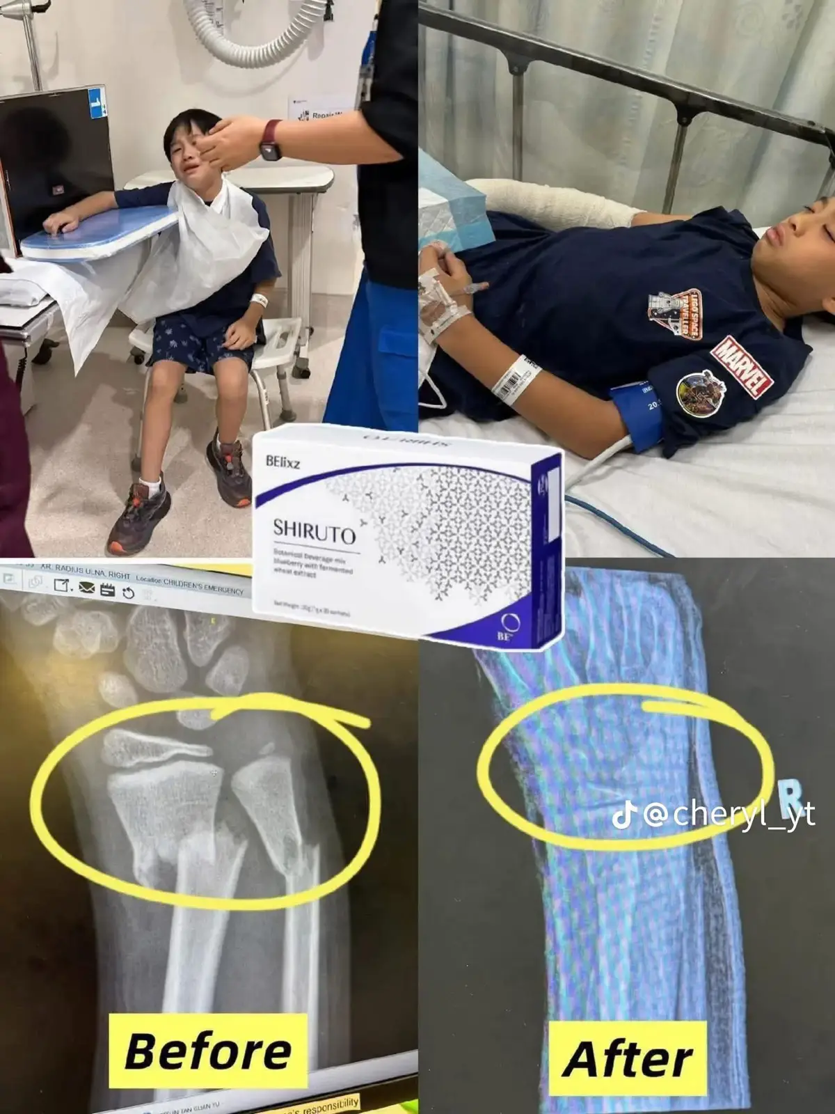 TQ BEians for sharing ❤️ Pada 1/9/25, anak kecil saya terjatuh di taman permainan dan patah tangan 💔. Di Jabatan Kecemasan 🚑, doktor memasang cast dan memberikan ubat tahan sakit 3 kali sehari. Tapi sebagai seorang ibu, saya juga beri dia Shiruto 2 sachet, 3 kali sehari) untuk sokong pemulihan.  Mengejutkan, dia hanya perlukan ubat tahan sakit sekali sahaja pada malam pertama! Dan langsung tak rasa sakit tanpa ubat tahan sakit. Proses pemulihan dia sangat cepat, masih tersenyum, aktif bermain, dan penuh tenaga 😌. #patahtangan #testimonishiruto #shirutobukanubat #shirutogantiubattahansakit #bantupemulihan