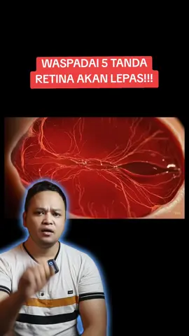 Ada jutaan orang di Indonesia mengalami retina lepas. Dan kamu tahu ga? Retina lepas adalah salah satu permasalahan mata yang tidak bisa disembuhkan! Mari sama-sama kita jaga mata kita dan keluarga dari resiko ini dengan rutin minum SOCA Setiap hari. Kandungan Alaminya mampu memperkuat dinding retina, menutrisi saraf mata, menghambat miopi dan menjaga ketajaman penglihatan. Sudah ribuan orang mengkonsumsi SOCA dan puas dengan hasilnya. Amankan SOCA sekarang juga dengan cara klik keranjang kuning di video ini. Jaga penglihatanmu dan keluarga dengan SOCA Sekarang Juga Sebelum Terlambat!. #socanaturaleyacare #kesehatanmata 