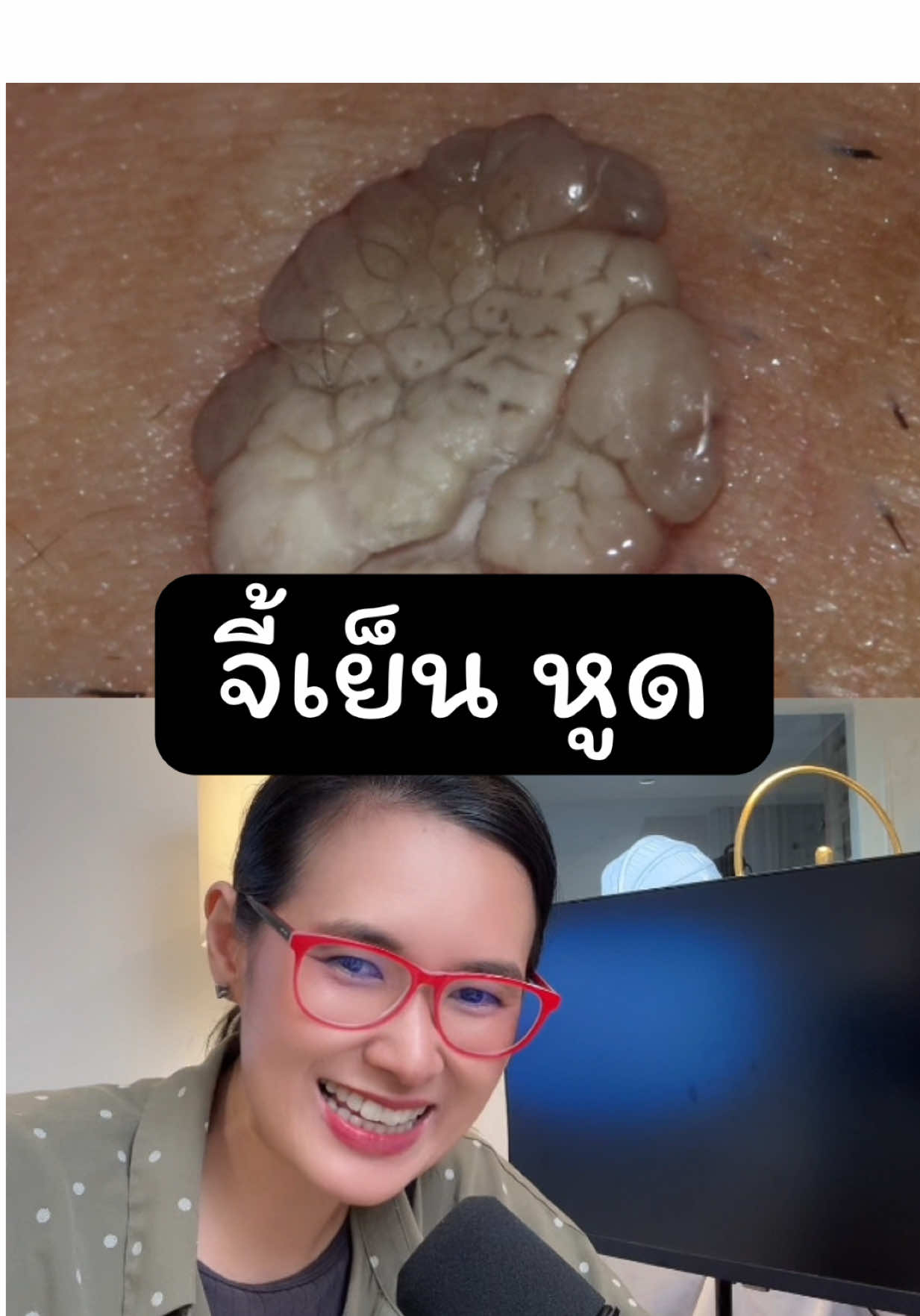 รักษาหูดหนอนไก่ ด้วยการจี้เย็น#หูดหงอนไก่#รักษาหูดหงอนไก่#จี้เย็น#cryotherapy