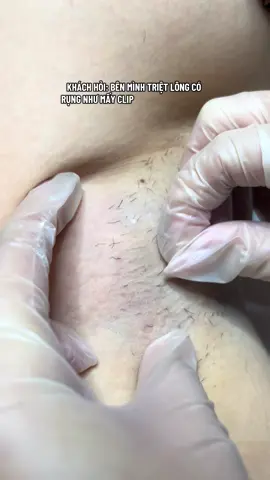 Kết quả sau lần đầu triệt đây ạ, đụng là rụng 😌 Khách hỏi sao đợt trước em triệt chỗ kia 10 lần mà không có rụng như bên chị 🙂‍↔️ Rụng cỡ này thì lên thưa cỡ nào 🤭🫣 #trietlongnhatrang #trietlongvinhvien #trietlongcongnghecao #trietlong #trietlongnach 