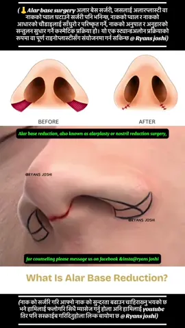Alar base surgery, also known as alarplasty or nostril reduction surgery, is a cosmetic procedure to narrow and refine wide or flared nostrils by removing a small amount of tissue at the base of the nose. The surgery can be a standalone procedure or part of a more extensive rhinoplasty, using hidden incisions to reduce nostril width and improve nasal proportions and overall facial balance.  What it is and why it's done Goal: To create a more aesthetically harmonious nose by narrowing the widest part of the nostrils.  Indications: The surgery is sought by individuals with flared nostrils, a broad alar base, or nasal asymmetry who want a more refined and balanced look.  Procedure: Surgeons remove small wedges or other small pieces of tissue from the alar base.  Techniques: Common techniques include wedge excision and Weir excision, a modified technique for precise nostril reshaping.  Combination: Alar base reduction can be performed as part of a full rhinoplasty or as a separate, focused procedure.  The surgical process  Anesthesia: Typically performed under local anesthesia with sedation, though it can also be under general anesthesia. Incisions: Incisions are carefully placed within the natural creases of the nostrils to keep scarring minimal. Duration: The procedure usually takes one to two hours. Recovery and Results Recovery time: Recovery is generally quicker than a full rhinoplasty, with normal activities resuming within a week.  Downtime: Stitches are typically removed after 5–7 days, and full recovery can take a few weeks to a few months.  Benefits: The procedure can improve nasal symmetry, reduce nostril size, and create a more proportional and aesthetically pleasing nose.  Important considerations Age: Patients should have completed facial development, which typically occurs between the ages of 13-14 for girls and 15-16 for boys.  Risks: Potential risks include common surgical complications like infection, bleeding, swelling, and bruising.  Consultation: It is important to have a thorough consultation with a qualified plastic surgeon to determine if alar base reduction surgery is right for you and to discuss your goals and the best approach for your anatomy. #nosealarbase #foryoupage❤️❤️ #fypage #goviral #kathmandunepal ❤️❤️
