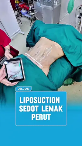 Klinik Sedot Lemak dan Abdominoplasti Dr. Jun #Trending #drjun #sedotlemak #liposuction #perut 