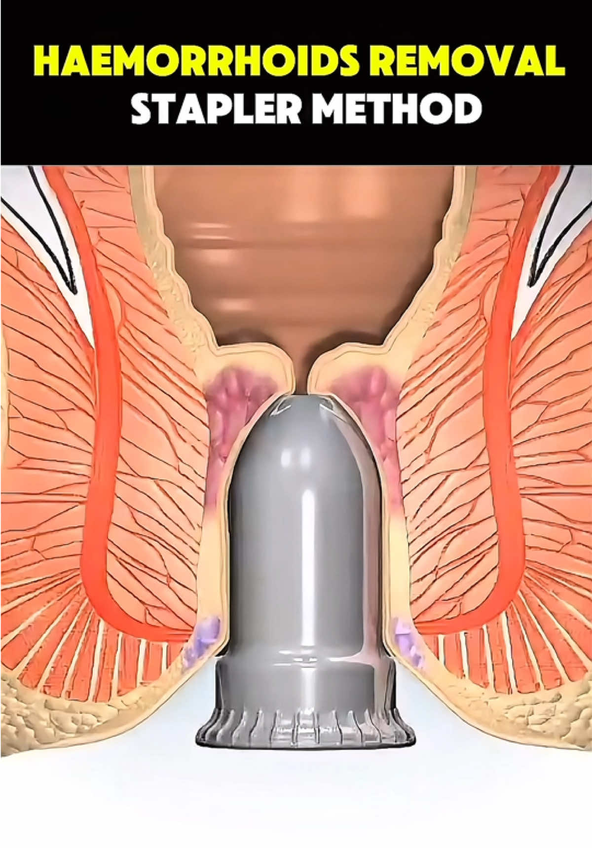 Haemorrhoids Removal ; Stapler method #HemorrhoidRemoval #HemorrhoidSurgery #ColorectalHealth #MinimallyInvasiveSurgery #fyp 