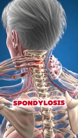 Are you having this symptom? You have cervical spondylosis #cervical #spondylosis #nervepain #healthtip #usa 