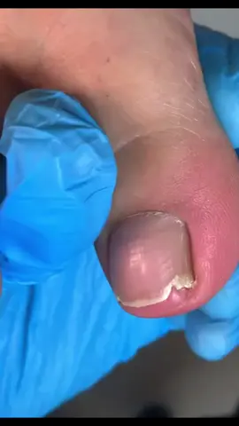 Pedicure #fyp #fypシ #pedicure #ingrowntenail 