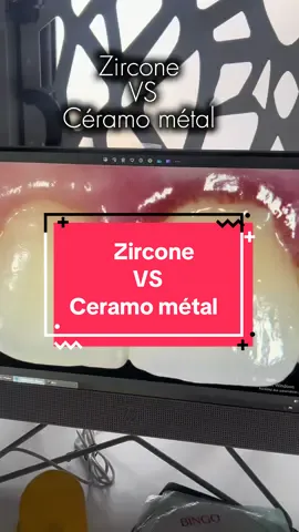 الفرق بين الزيركون و السيراميك #zircone #dentiste #hollywoodsmile #زيركون #implant 