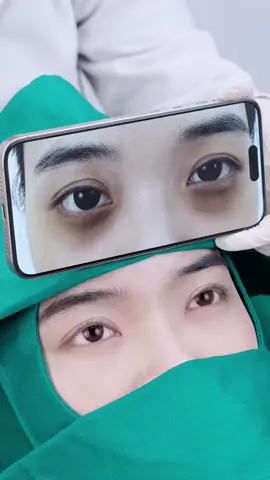 TRƯỚC VÀ SAU QUÁ TRÌNH ĐIỀU TRỊ THÂM MẮT CỦA CHỊ THẢO ANH TẠI PHÒNG KHÁM. #phongkhamquocteuni #thâmmắt #thâm_quầng_mắt 