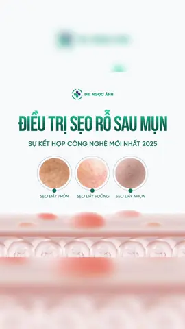 🔶ĐIỀU TRỊ SẸO RỖ SAU MỤN BẰNG HEALING SCAR – Sự kết hợp công nghệ mới nhất 2025  Bạn bị sẹo rỗ, chữa mãi không hết? Bsi mang đến liệu trình phục hồi làn da đặc biệt: Phác đồ cá nhân hóa kết hợp đa công nghệ, phương pháp điều trị 👉 Tác động sâu và chính xác tới vùng da bị sẹo. 👉 Kích thích collagen mới, làm đầy sẹo rỗ & se khít lỗ chân lông. 👉 Da phục hồi nhanh, mịn màng, không lo thâm nám (PIH). 👉 Đặc biệt hiệu quả với sẹo rỗ đáy nhọn – loại khó chữa nhất. ✅INBOX để được tư vấn --------