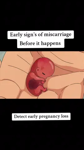 early sign's of miscarriage before it happens #EarlyMiscarriageSigns  #MiscarriageSymptoms  #PregnancyComplications  #MiscarriageWarningSigns  #earlypregnancyloss 
