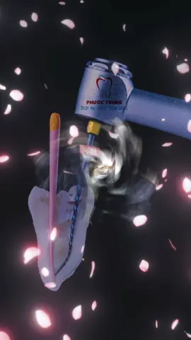 🦷✨ Điều trị tủy: Trâm tay với Trâm máy – khác biệt ở đâu? ✨🦷 👉 Với trâm tay, thời gian lâu hơn, dễ gây khó chịu. 👉 Với trâm máy hiện đại, ống tủy được làm sạch nhanh chóng – chính xác – an toàn, bệnh nhân thoải mái hơn, bác sĩ hiệu quả hơn. 💙 Tại Nha khoa Phước Trung, chúng tôi áp dụng nội nha trâm máy tiên tiến, giúp: ✅ Giảm đau – tiết kiệm thời gian ✅ Giữ răng thật lâu dài ✅ Hạn chế biến chứng sau điều trị #nhakhoaphuoctrung #nhakhoauytin #cantho #xuhuong #chuatuyrang 