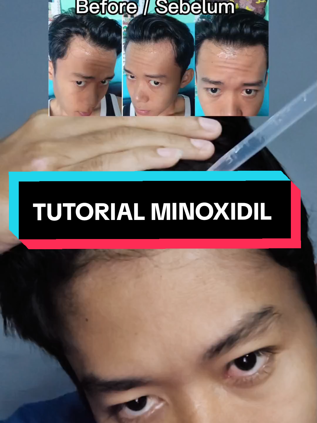 Membalas @unknowuser000.1 Tutorial menggunakan Minoxidil: -Pakai minimal 2x sehari untuk hasil yg maksimal -Pakai di kulit kepala yang mengalami penipisan rambut ataupun Kebotakan, bisa juga di pakai di kulit alis kalau ingin menebalkan alis, atau kumis jenggot ataupun di oles di area brewok kalau ingin menumbuhkan brewok. -sebaiknya jangan di oles di area bulu mata karena takutnya bisa kena mata -sehabis pakai jangan langsung di bilas, diamkan agar meresap minimal 4 jam. -Untuk Kebotakan genetik dari orang tua wajib pakai DHT Blocker, agar rontok berkurang.  -Perubahan Terlihat rata-rata 3 sampai 6 bulan tiap orang beda-beda, ada yang cepat ada juga yang lebih lambat.