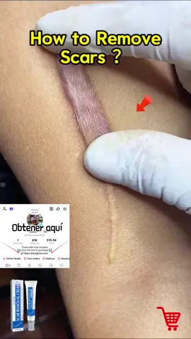Say goodbye to scars from knives, surgeries, burns, stretch marks, and pregnancy in just 30 days!#foryou #fyp #fyp #scar #nurse