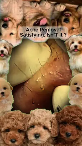 #squeezeyuk #satisfying #pimple #foryou #relax #fyp 