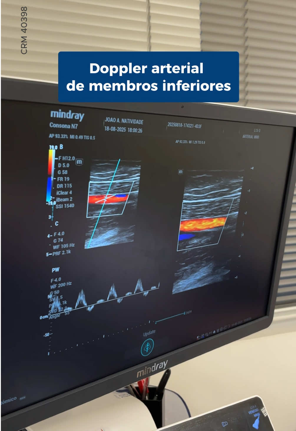 Sentiu dor na panturrilha ao andar e precisou parar um pouco pra passar? Tem pés sempre frios, com a pele ressecada ou unhas que demoram a crescer? ⠀ Esses sinais, que muita gente ignora, podem indicar problemas arteriais nos membros inferiores. ⠀ O Doppler arterial permite avaliar o fluxo sanguíneo nas pernas e detectar precocemente doenças como a doença arterial obstrutiva periférica (DAOP). ⠀ Quanto antes identificado, mais chances temos de tratar sem cirurgias ou complicações. ⠀ Cuide das suas pernas, elas te sustentam, te levam, te movimentam. ⠀ Salva esse vídeo e envia pra alguém que anda se queixando de dor ou cansaço nas pernas!