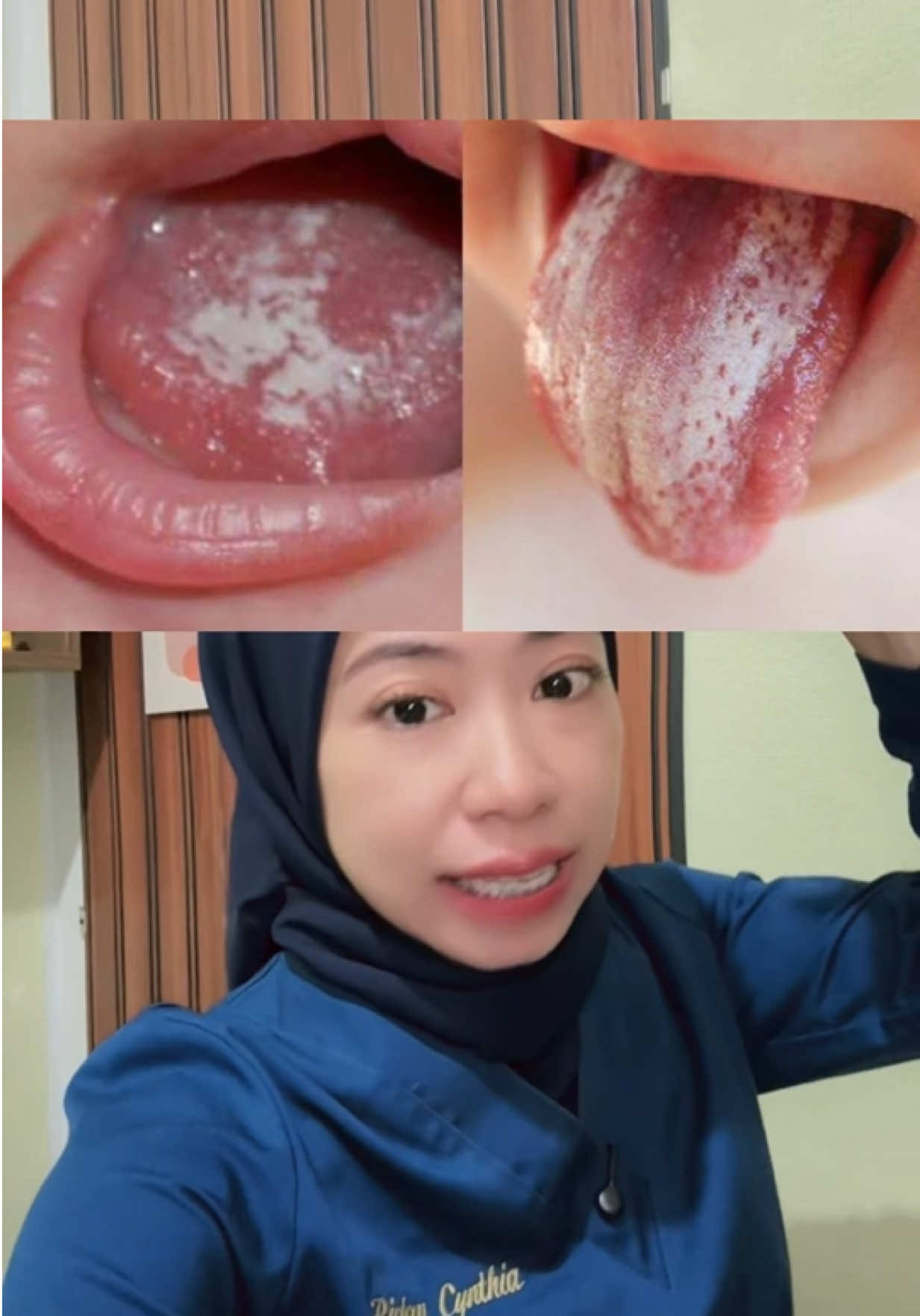 Cara bersihin lidah bayi , biar ga infeksi jamur #oralcleaner #pembersihlidahbayi #pembersihlidah 